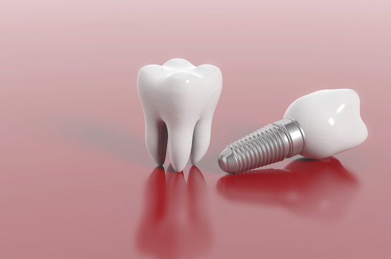 インプラント治療とは？