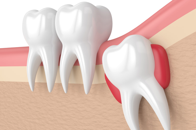 親知らずでお困りではありませんか？