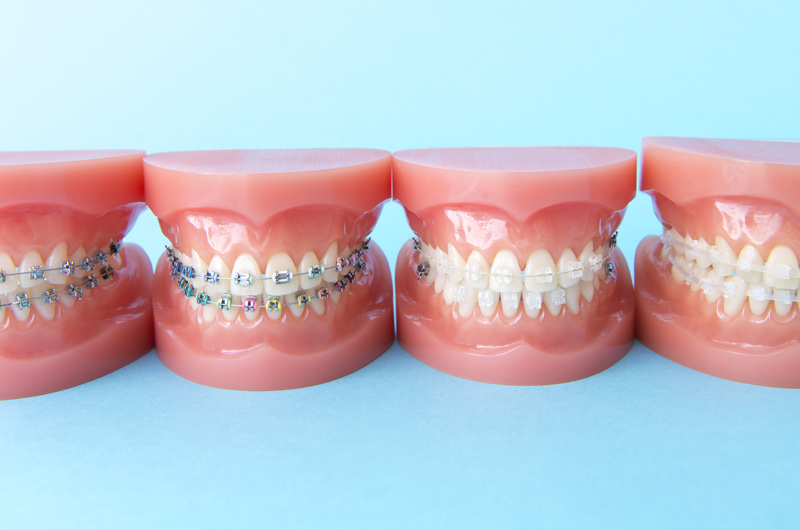 一般矯正（ブラケット矯正）
