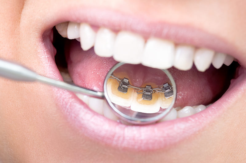 舌側矯正（裏側矯正）