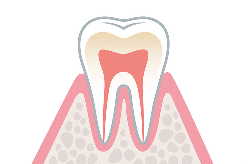 歯肉炎（初期）