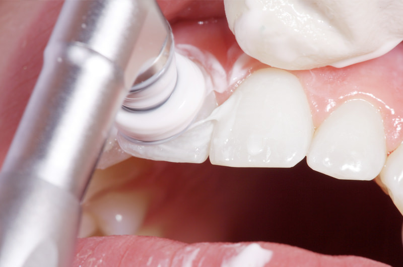 PMTC（プロによる歯のクリーニング）